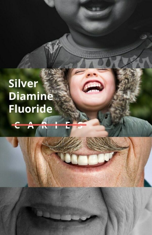 Dengen Caries Arrest Silver Diamine Fluoride 38% - Image 5